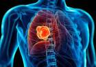 Día Internacional de la Lucha Contra el Cáncer de Pulmón
