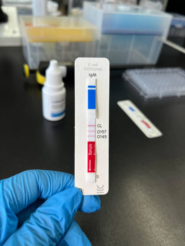 Cómo es el revolucionario test que detecta el síndrome urémico hemolítico en 10 minutos