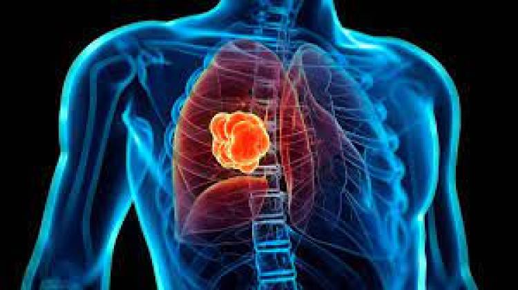 Día Internacional de la Lucha Contra el Cáncer de Pulmón